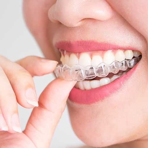 Accessori-per-apparecchi-ortodontici