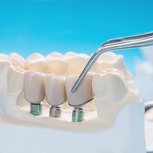 Accessori-per-protesi